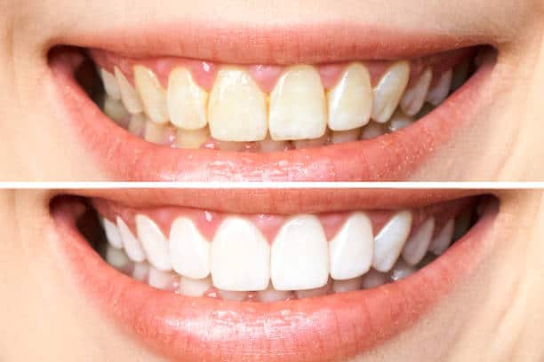 Achieve a Dazzling Smile for Your Special Day: A Guide to Wedding Teeth Whitening St Albans