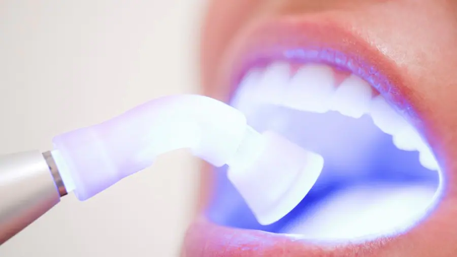 Teeth Whitening Aylesbury St Albans