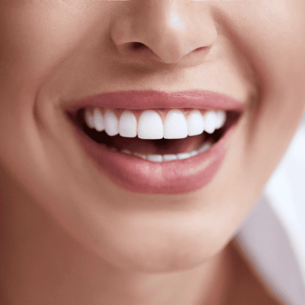 Get A whiter smile fast! Book with LA Teeth Whitening today! St Albans