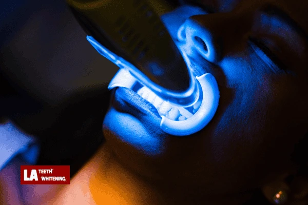 Looking for laser teeth whitening? Book in today! St Albans