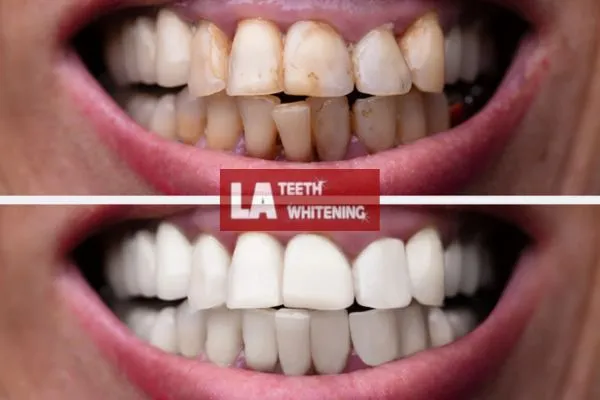 Before-and-after teeth whitening results using a home laser system St Albans