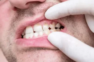 does teeth whitening weaken the teeth St Albans